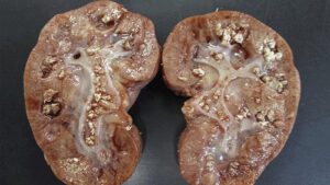 nước cứng gây bệnh sỏi thận